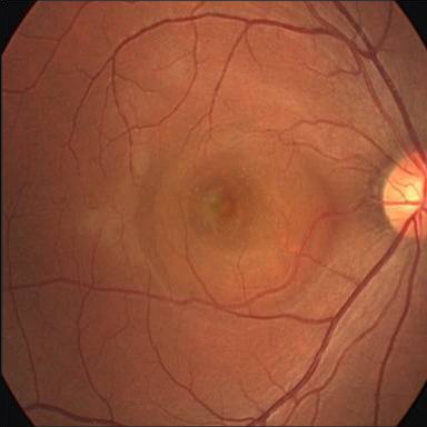中心性漿液性脈絡網膜症