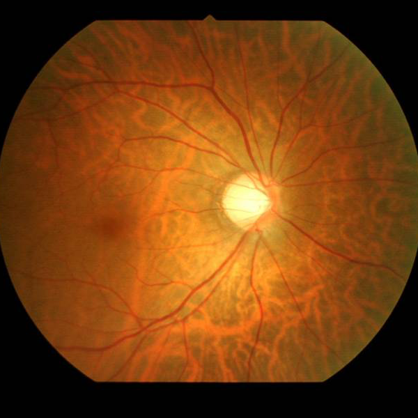 緑内障の疑いとは？