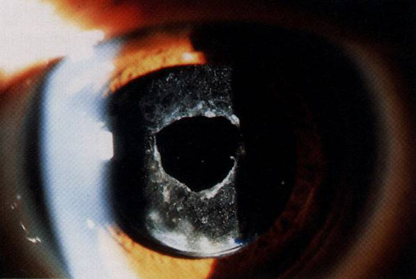 レーザー後嚢切開術