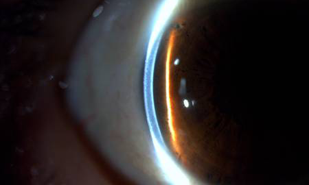 レーザー虹彩切開術