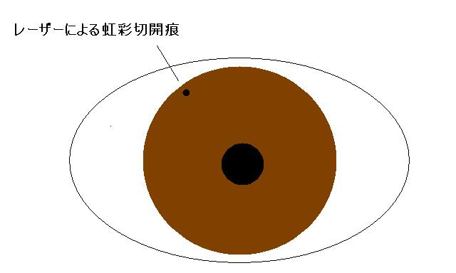 レーザー虹彩切開術