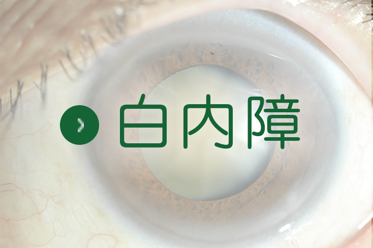 白内障